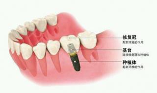 种植牙能用多长时间